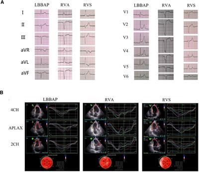 Comparison between left bundle branch area pacing and right ventricular pacing: ventricular electromechanical synchrony and risk of atrial high-rate episodes